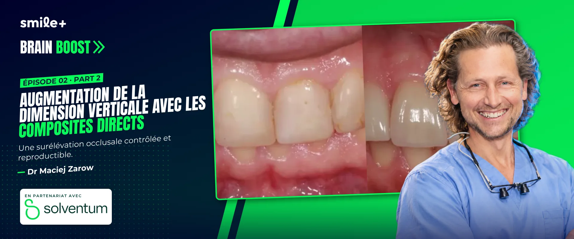 Augmentation de la dimension verticale avec les composites directs - part1 (Brain Boost)