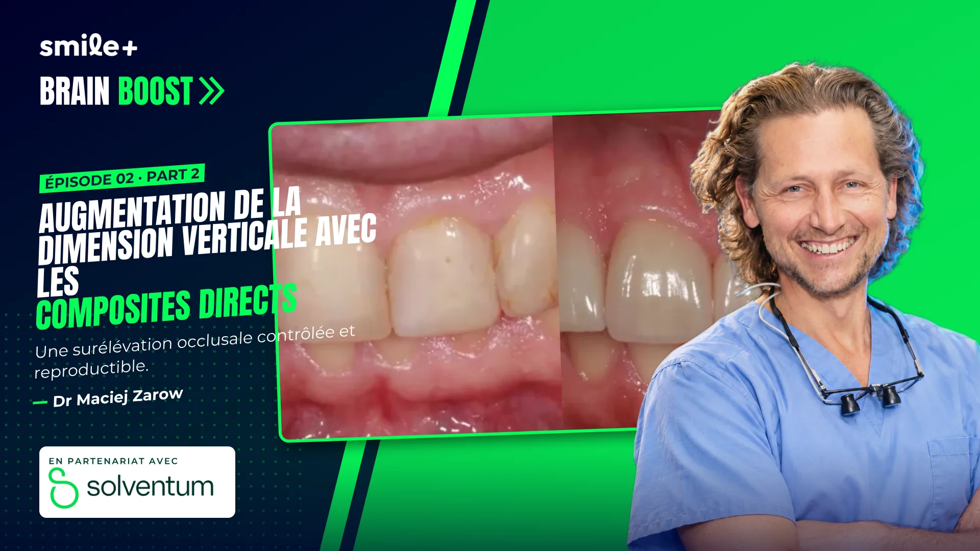 Augmentation de la dimension verticale avec les composites directs - part1 (Brain Boost)