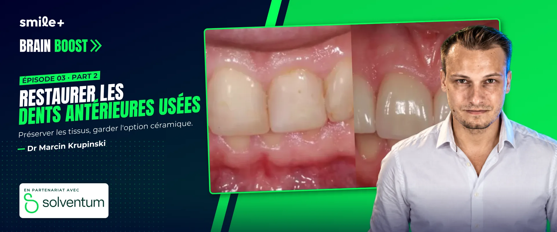Restaurer les dents antérieures usées - part1 (Brain Boost) : Conférence et atelier du Dr Marcin Krupinski : restaurer les dents antérieures usées…