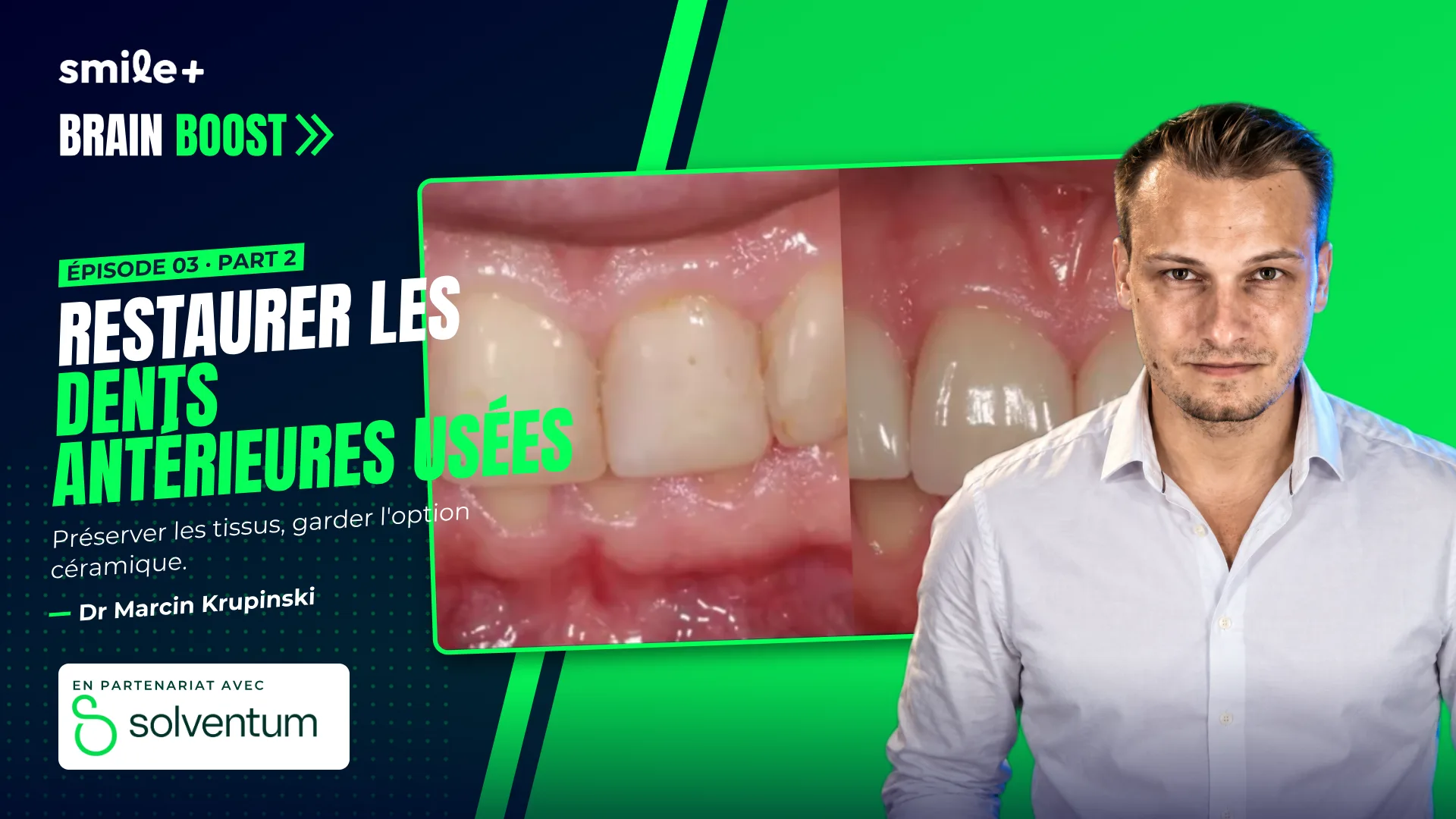 Restaurer les dents antérieures usées - part1 (Brain Boost) : Conférence et atelier du Dr Marcin Krupinski : restaurer les dents antérieures usées…
