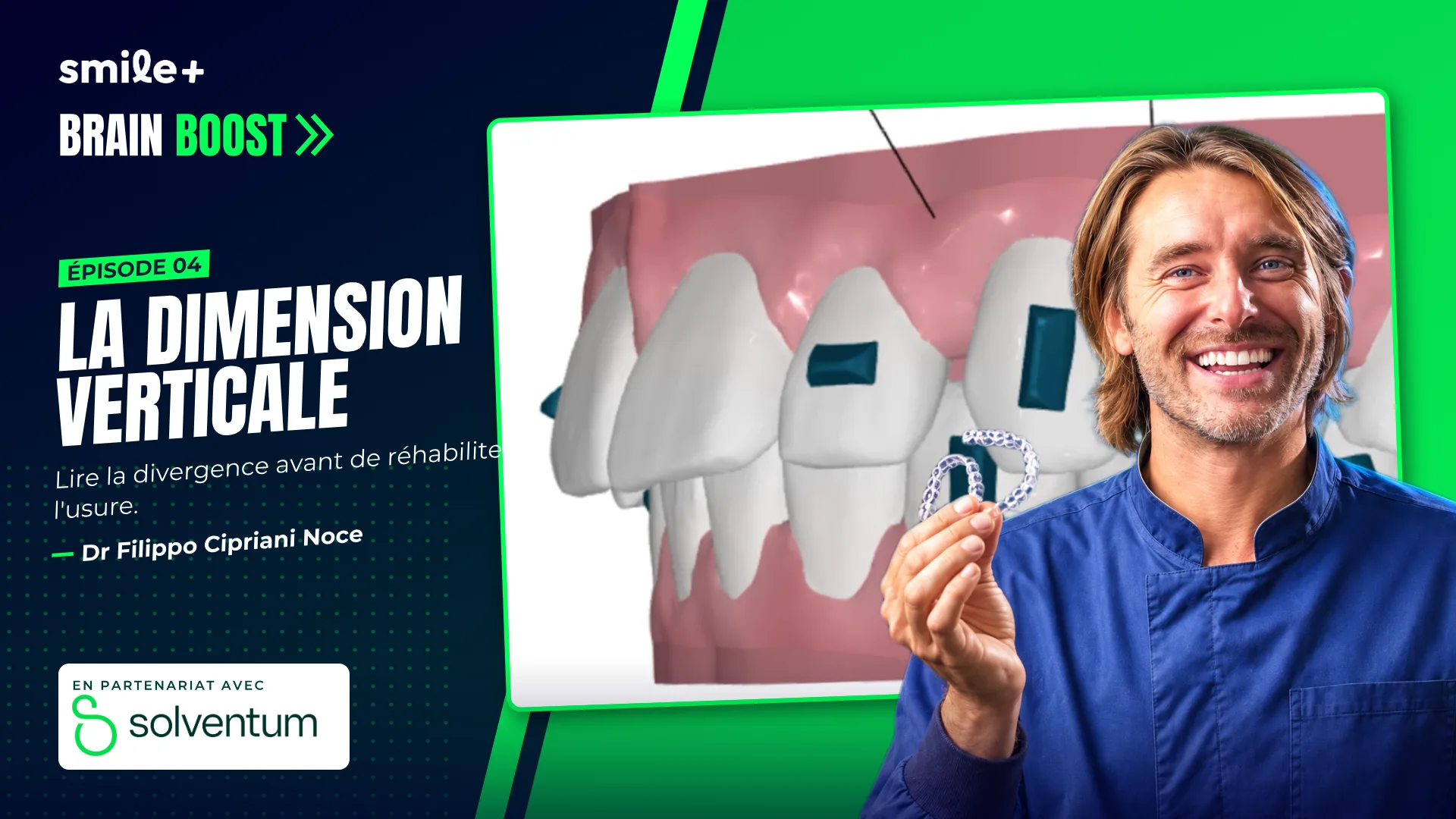 La dimension verticale (Brain Boost) : Conférence du Dr Filippo Cipriani Noce : la dimension verticale abordée sous l'angle orthodontique, un point…