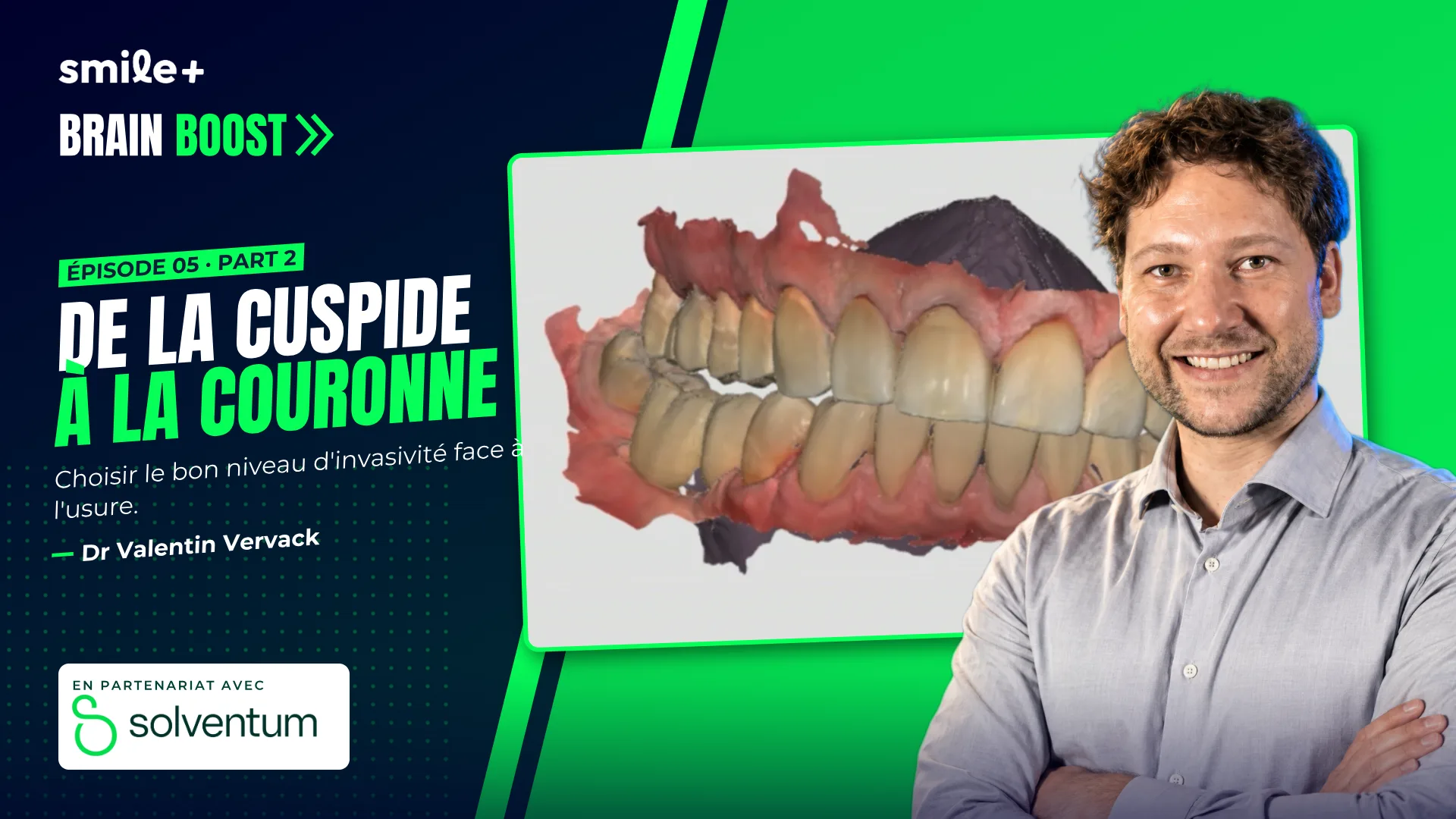 De la cuspide à la couronne - part2 (Brain Boost) : Atelier pratique du Dr Valentin Vervack : reconstruire les cuspides sur molaire usée et préparer…