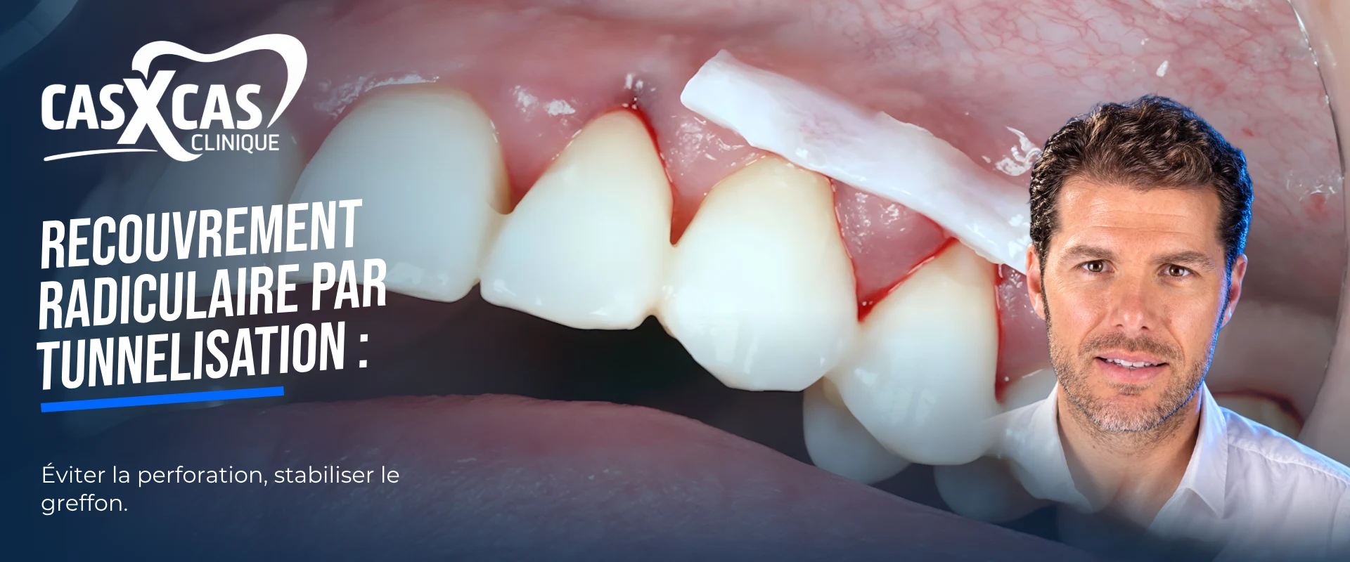 Chirurgie de recouvrement radiculaire par tunnelisation : mise en place et désépithélialisation (Cas par Cas, saison 2 épisode 3)