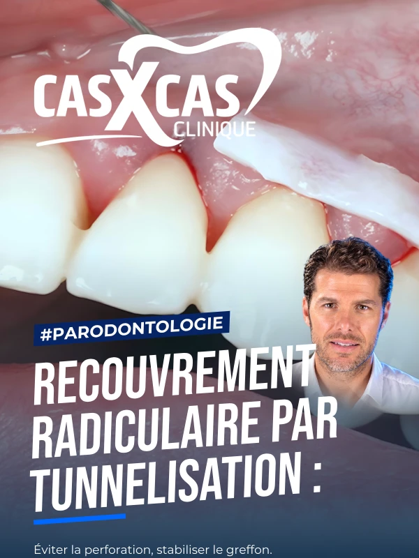 Chirurgie de recouvrement radiculaire par tunnelisation : mise en place et désépithélialisation (Cas par Cas, saison 2 épisode 3)