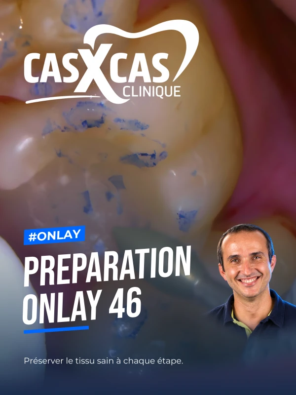 Preparation onlay 46 (Cas par Cas, saison 2 épisode 7) : Démonstration muette du Dr Gauthier Weisrock : première partie de la préparation d'un onlay…