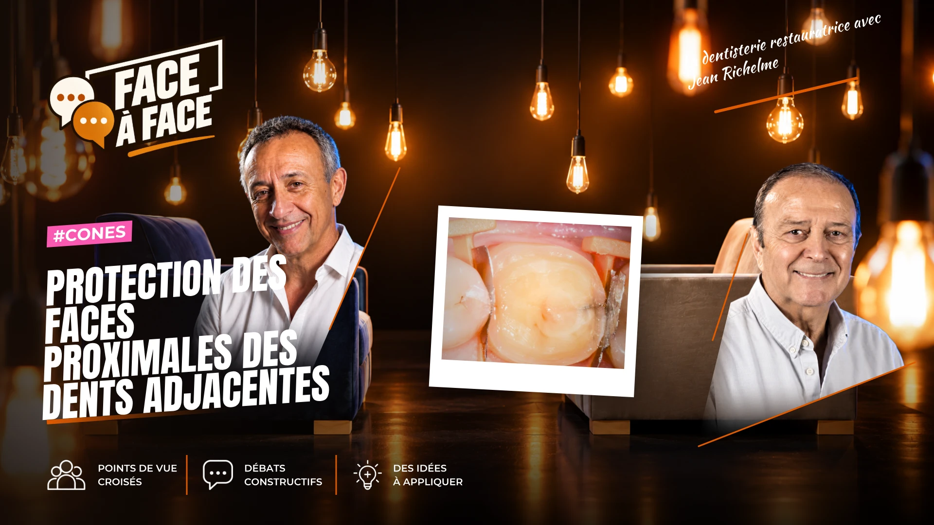 Protection des faces proximales des dents adjacentes (Face à Face, saison 1 épisode 1) : Conserver l'anatomie des faces proximales des dents saines…