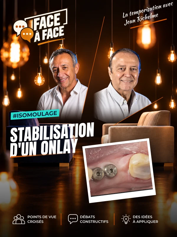 Stabilisation d'un onlay (Face à Face, saison 1 épisode 3) : Stabilisation d'un onlay dans le cas d'une dent très délabrée