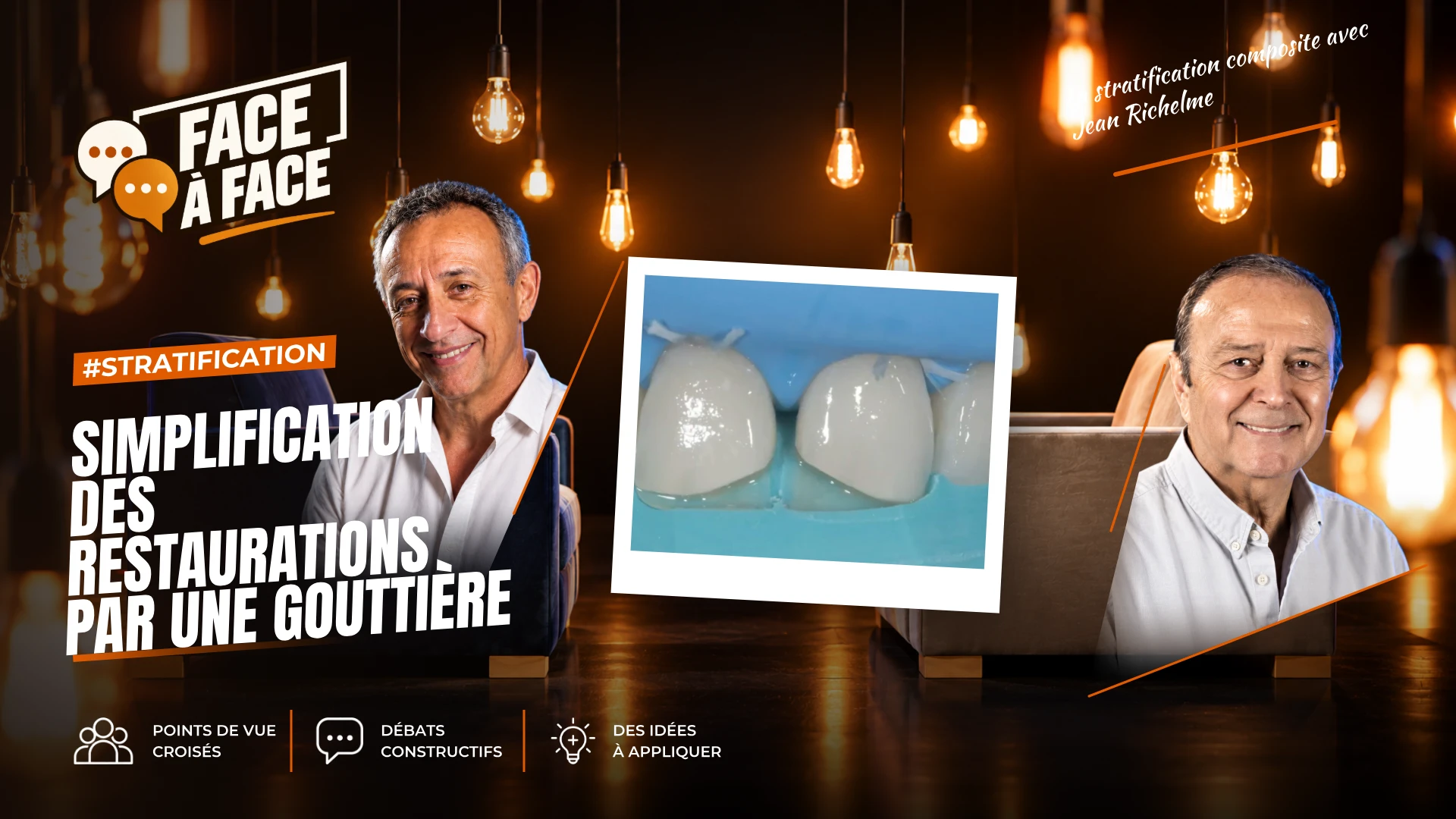 Simplification des restaurations par une gouttière (Face à Face, saison 1 épisode 6) : Restauration composite à l'aide d'une clé en silicone