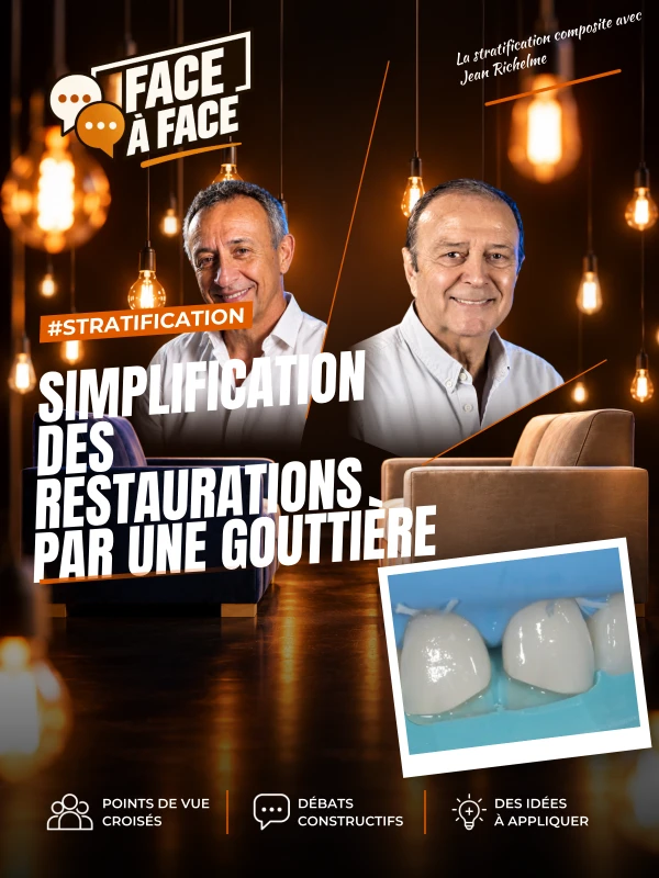 Simplification des restaurations par une gouttière (Face à Face, saison 1 épisode 6) : Restauration composite à l'aide d'une clé en silicone