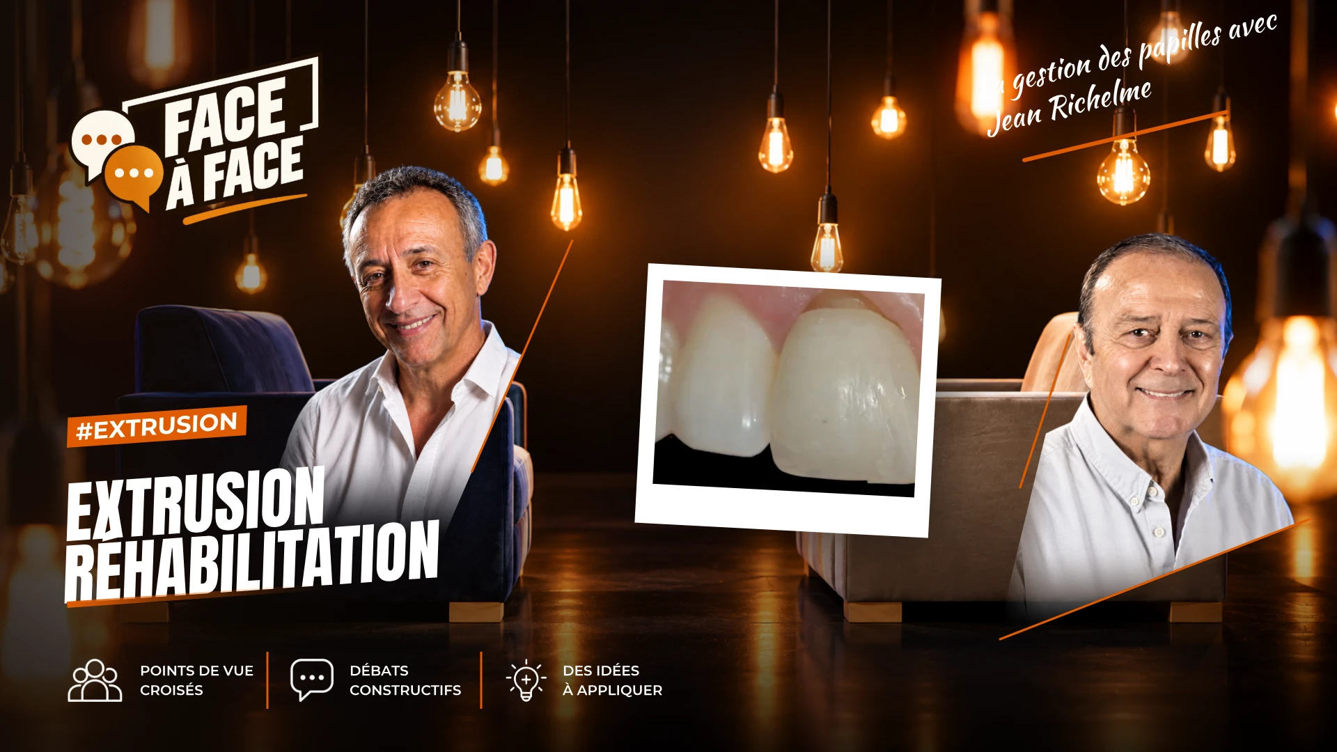Extrusion réhabilitation (Face à Face, saison 1 épisode 8) : Réhabilitation papillaire grâce à une technique d'extrusion orthodontique