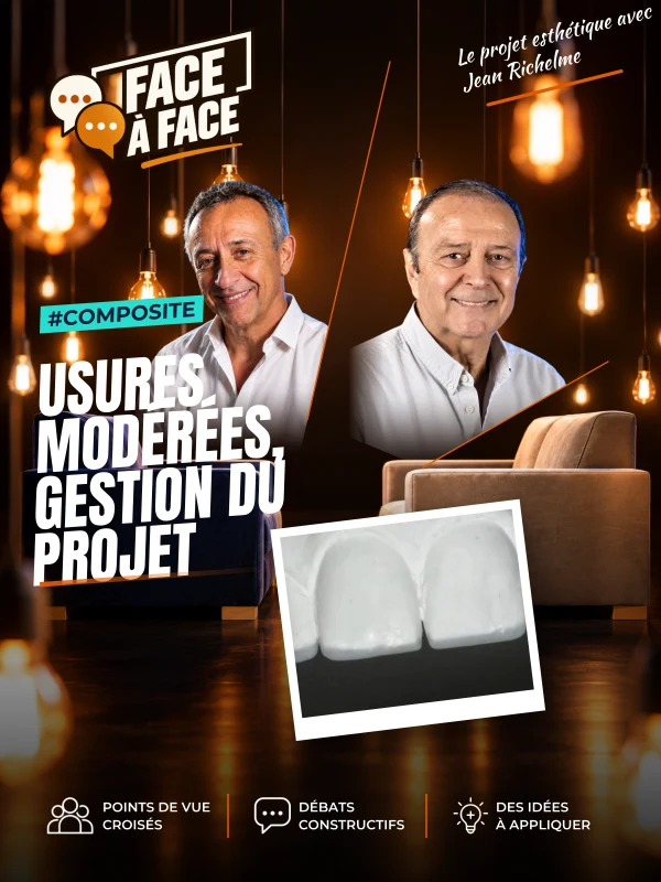Usures modérées, gestion du projet (Face à Face, saison 1 épisode 9) : Réharmoniser et pérenniser un sourire suite à des usures
