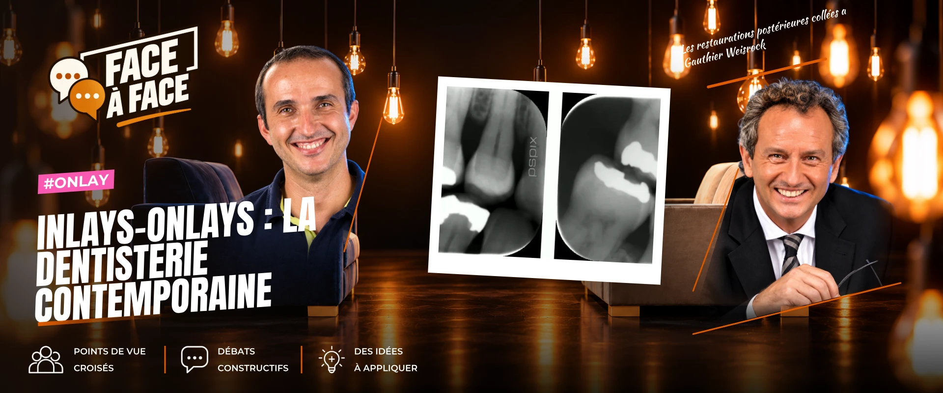 Inlays-onlays : la dentisterie contemporaine (Face à Face, saison 1 épisode 41) : Inlays Onlays : état des lieux de la dentisterie conservatrice…
