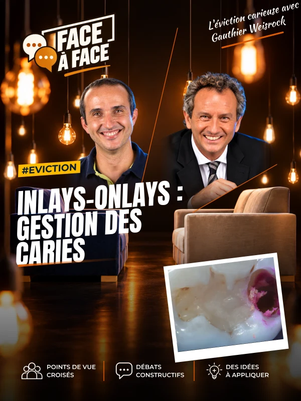 Inlays-onlays : gestion des caries (Face à Face, saison 1 épisode 43) : Inlays-Onlays : gestion des caries : de la compréhension de l'histologie aux…