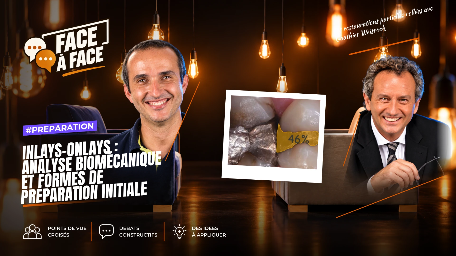 Inlays-onlays : analyse biomécanique et formes de préparation initiale (Face à Face, saison 1 épisode 45)