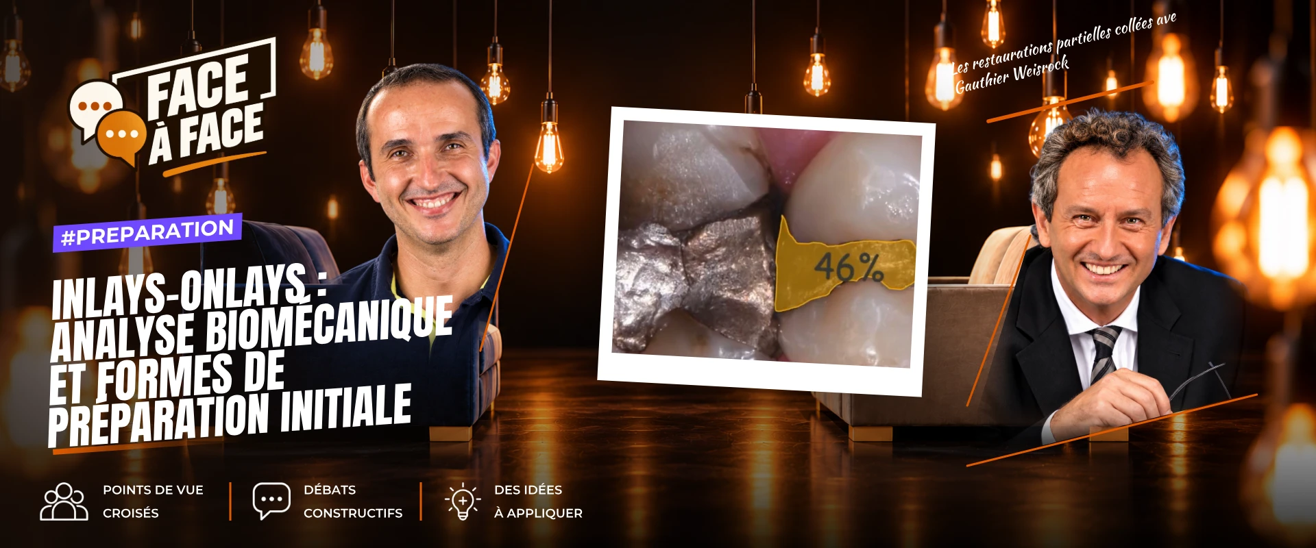 Inlays-onlays : analyse biomécanique et formes de préparation initiale (Face à Face, saison 1 épisode 45)