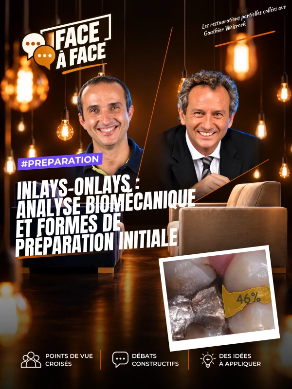 Inlays-onlays : analyse biomécanique et formes de préparation initiale (Face à Face, saison 1 épisode 45)