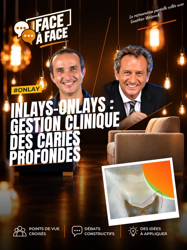 Inlays-onlays : gestion clinique des caries profondes (Face à Face, saison 1 épisode 47) : Inlays-Onlays : gestion clinique des caries profondes…