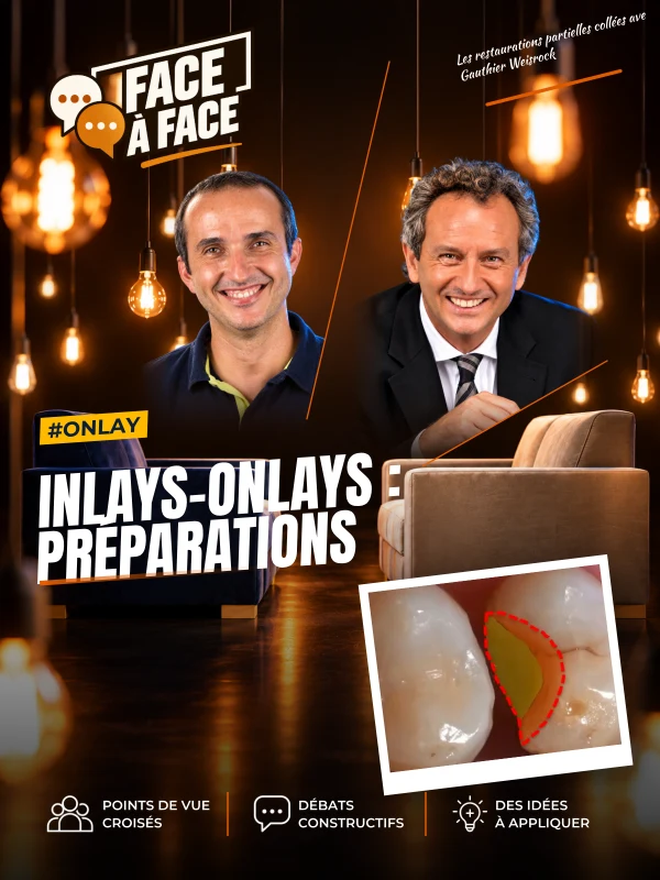 Inlays-onlays : préparations (Face à Face, saison 1 épisode 48) : Inlays-Onlays : Préparations .