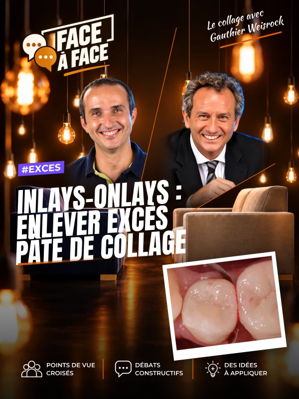 Inlays-onlays : enlever excès pâte de collage (Face à Face, saison 1 épisode 51) : Elimination des excès de pâte de collage.