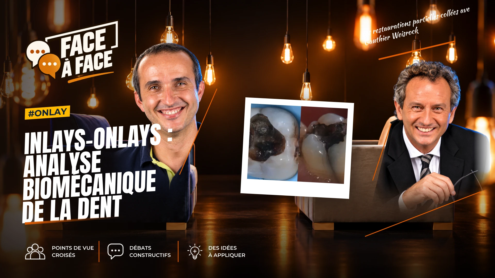 Inlays-onlays : analyse biomécanique de la dent (Face à Face, saison 1 épisode 53)