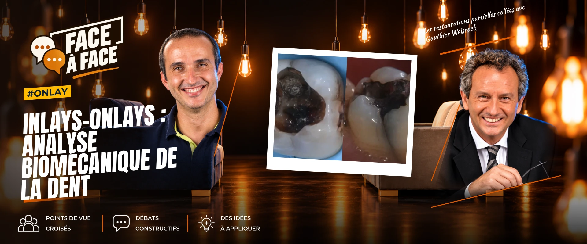 Inlays-onlays : analyse biomécanique de la dent (Face à Face, saison 1 épisode 53)