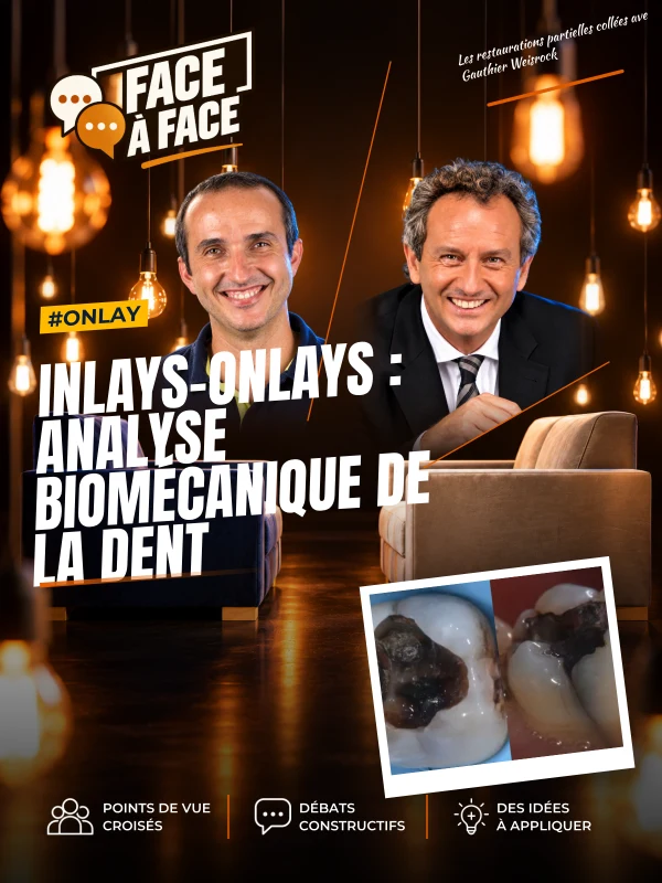 Inlays-onlays : analyse biomécanique de la dent (Face à Face, saison 1 épisode 53)