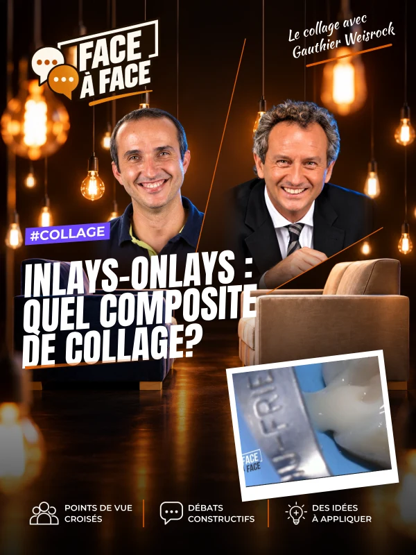 Inlays-onlays : quel composite de collage? (Face à Face, saison 1 épisode 59) : Inlays-Onlays : Quels composite de collage?