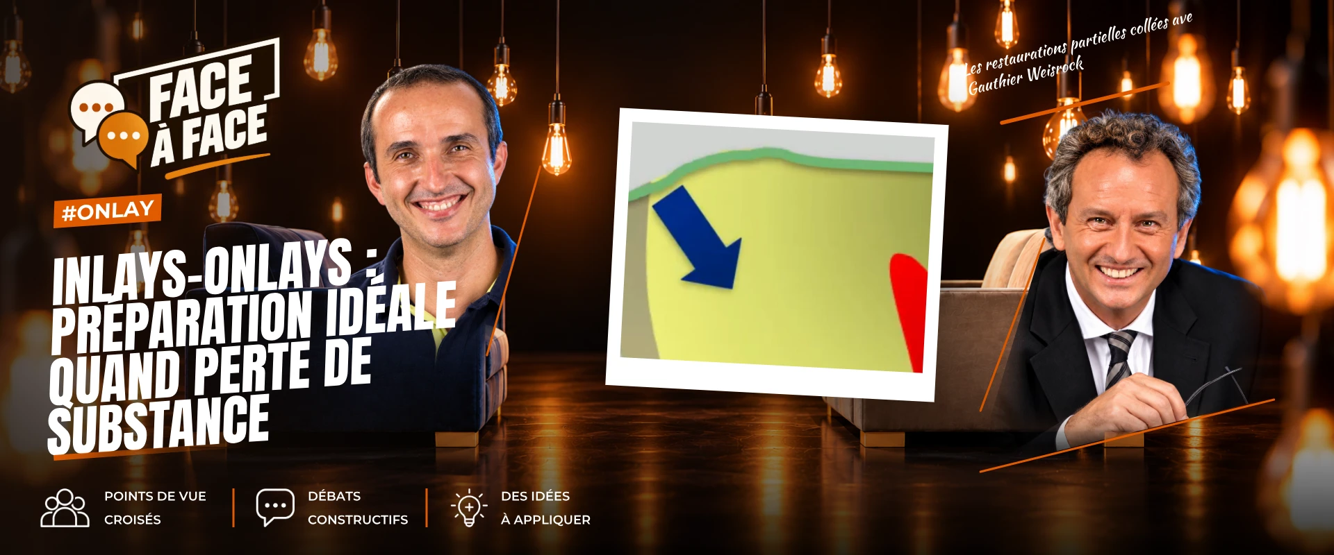 Inlays-onlays : préparation idéale quand perte de substance (Face à Face, saison 1 épisode 64)
