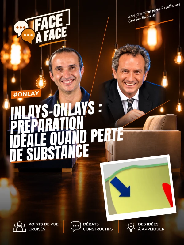 Inlays-onlays : préparation idéale quand perte de substance (Face à Face, saison 1 épisode 64)