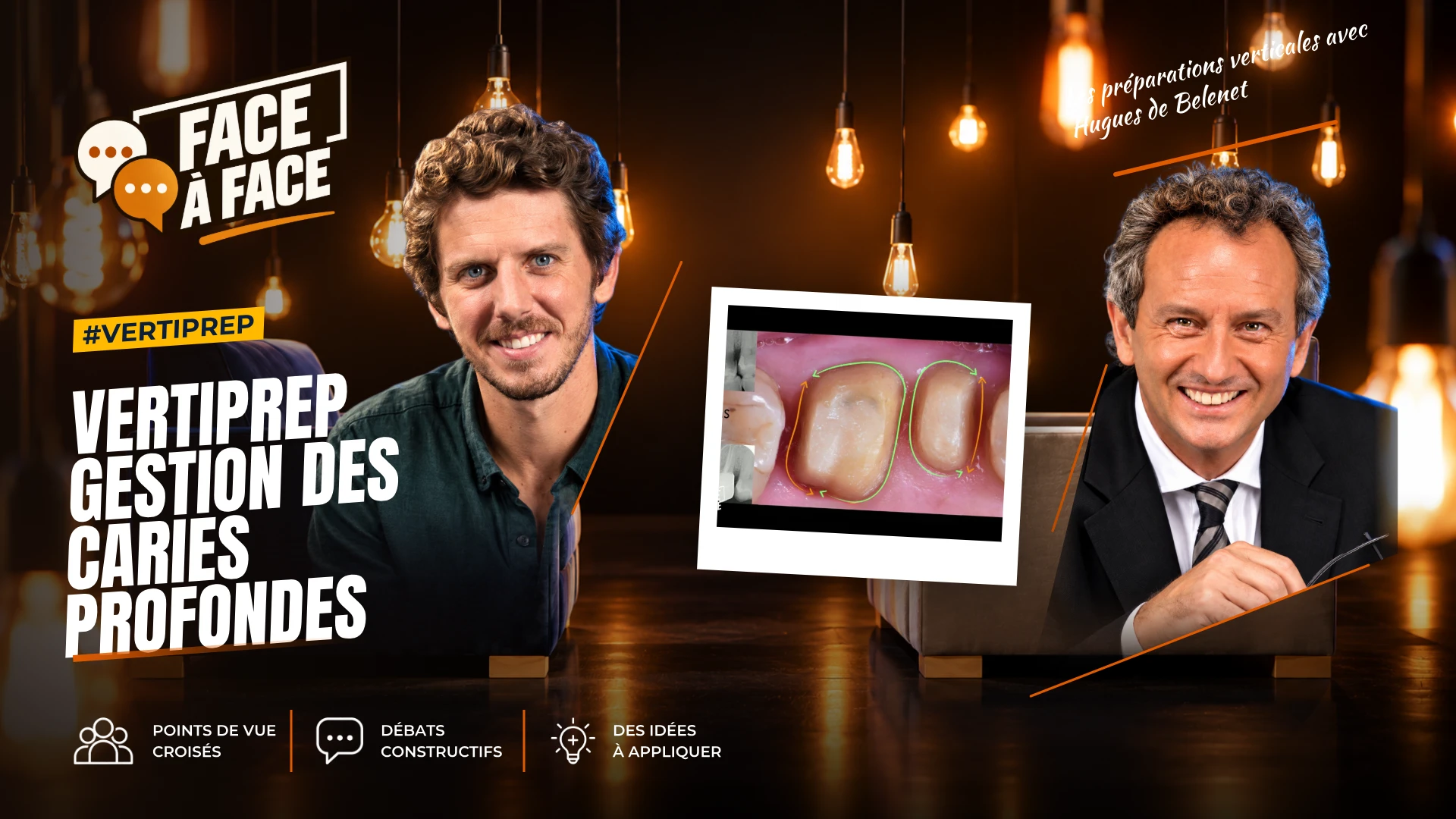 Vertiprep gestion des caries profondes (Face à Face, saison 2 épisode 8) : Caries sous-gingivales : élongation coronaire ou remontée de marge ?