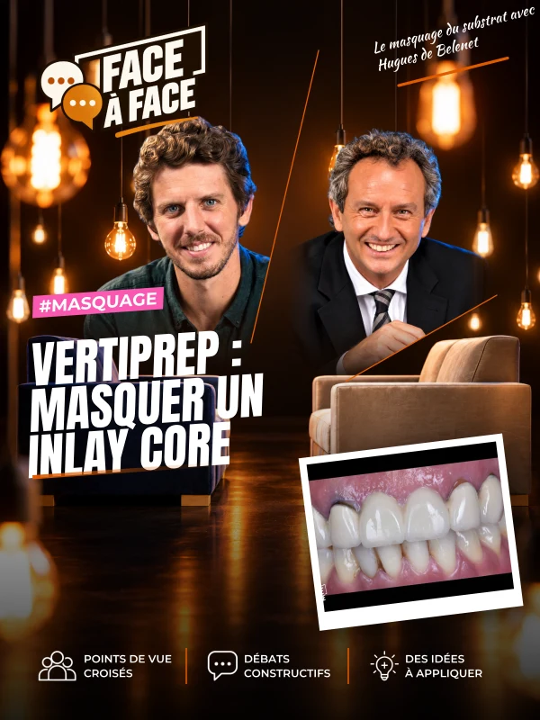 Vertiprep : masquer un inlay core (Face à Face, saison 2 épisode 11) : Comment masquer un substrat dyschromique en VertiPrep sans démonter un…
