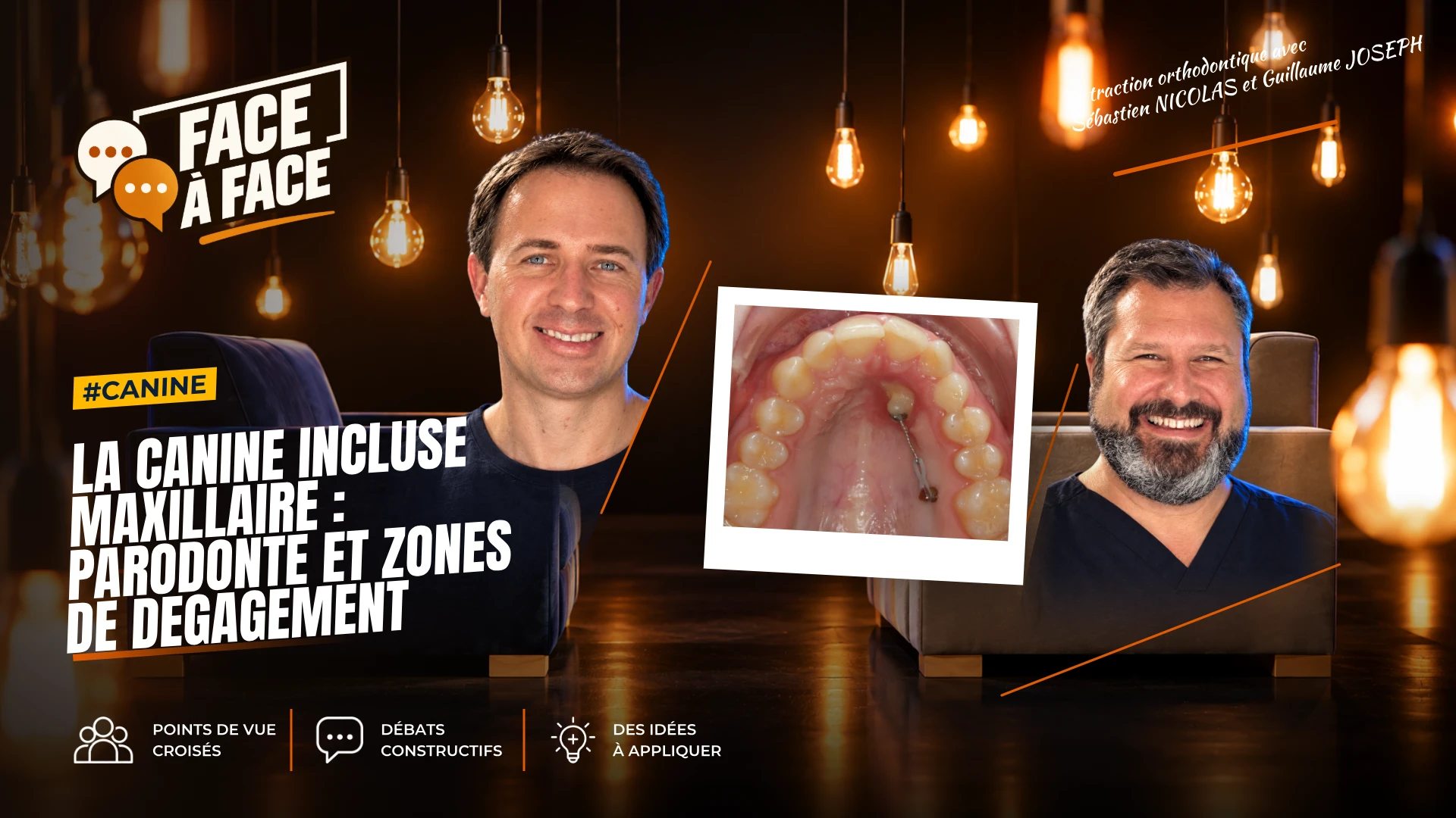 La canine incluse maxillaire : parodonte et zones de degagement