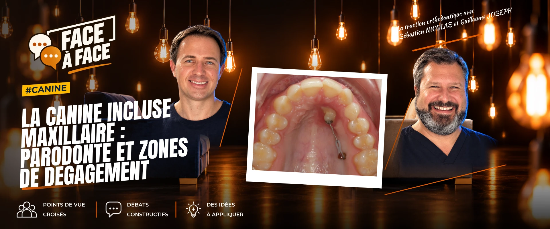 La canine incluse maxillaire : parodonte et zones de degagement