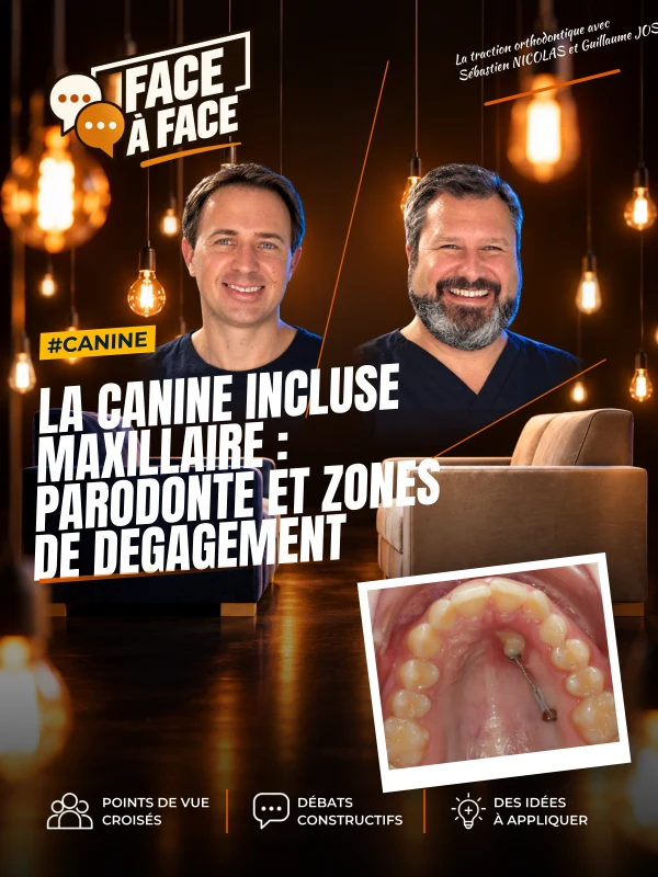 La canine incluse maxillaire : parodonte et zones de degagement 