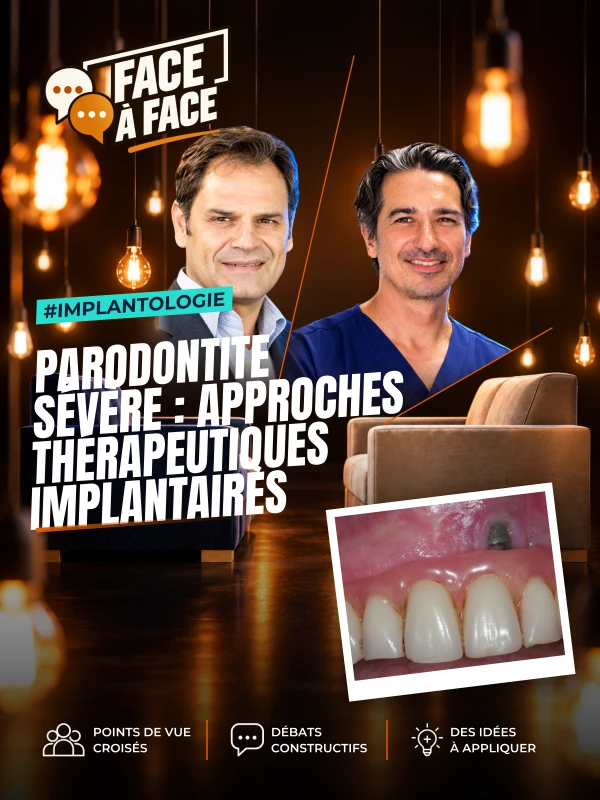 Parodontite sévère : approches thérapeutiques implantaires (Face à Face, saison 2 épisode 20) : Parodontite sévère : les approches thérapeutiques…