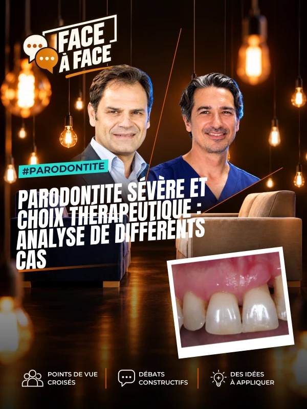 Parodontite sévère et choix thérapeutique : analyse de différents cas (Face à Face, saison 2 épisode 21) : Parodontite sévère : comment choisir la…