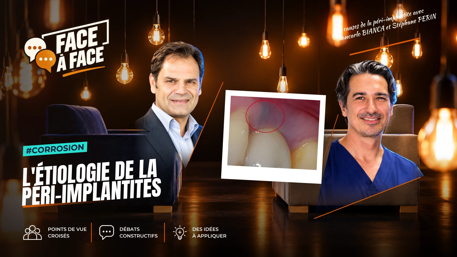 L'étiologie de la péri-implantites (Face à Face, saison 2 épisode 23) : L'étiologie de la péri-implantite au-delà du seul facteur bactérien : le…