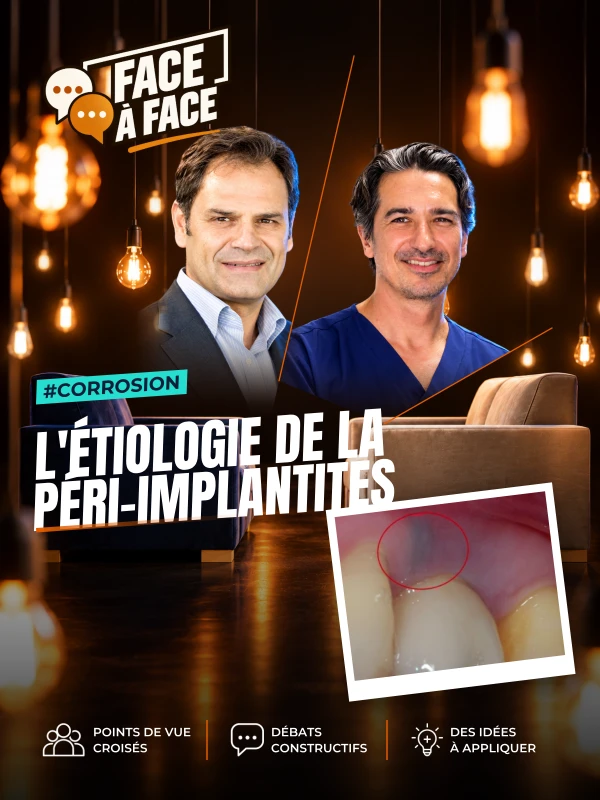 L'étiologie de la péri-implantites (Face à Face, saison 2 épisode 23) : L'étiologie de la péri-implantite au-delà du seul facteur bactérien : le…