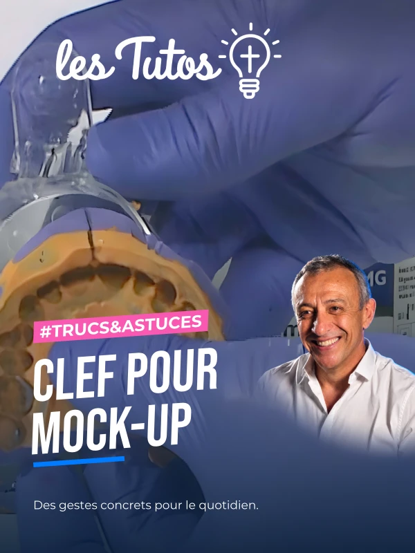 Clef pour mock-up (Tuto, saison 1 épisode 7) : Réalisation d'un porte-empreinte individualisé d'après un wax-up