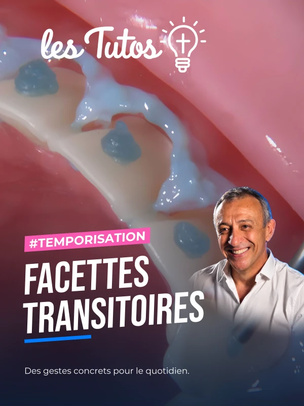 Facettes transitoires (Tuto, saison 1 épisode 14) : Réalisation de facettes transitoires en résine