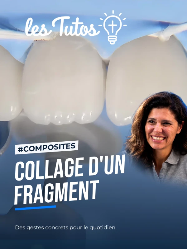 Collage d'un fragment (Tuto, saison 1 épisode 29) : Collage d'un fragment dans le cas d'une fracture sur une incisive centrale