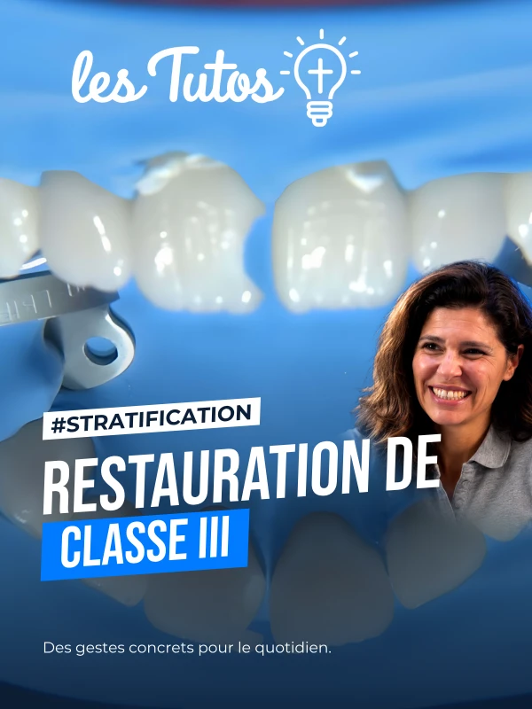 Restauration de classe iii (Tuto, saison 1 épisode 32) : Restauration de classe III par stratification en résine composite