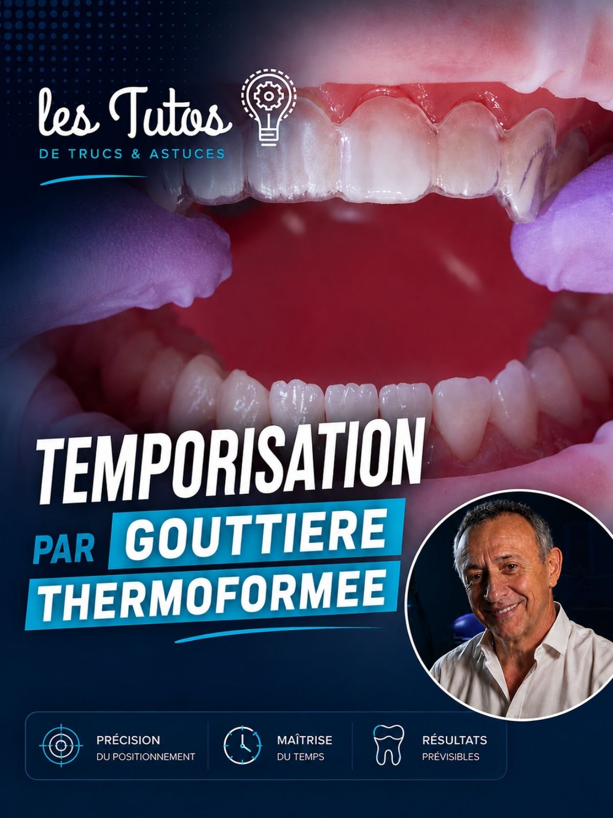 Temporisation par gouttière thermoformée (Tuto, saison 2 épisode 4) : Démonstration muette du Dr Jean Richelme : une gouttière avec dent intégrée en…