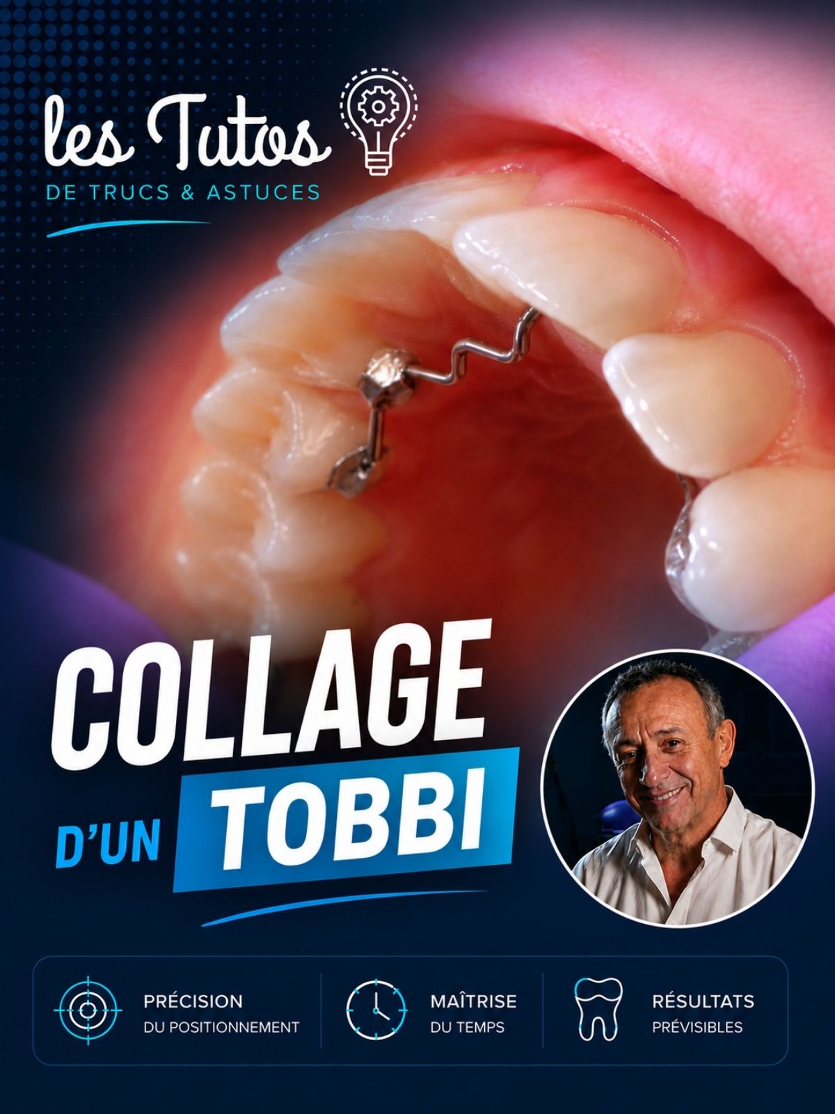 Collage d'un tobbi (Tuto, saison 2 épisode 5) : Démonstration muette du Dr Jean Richelme : le collage d'un TOBBI sous digue, du mordançage à la…