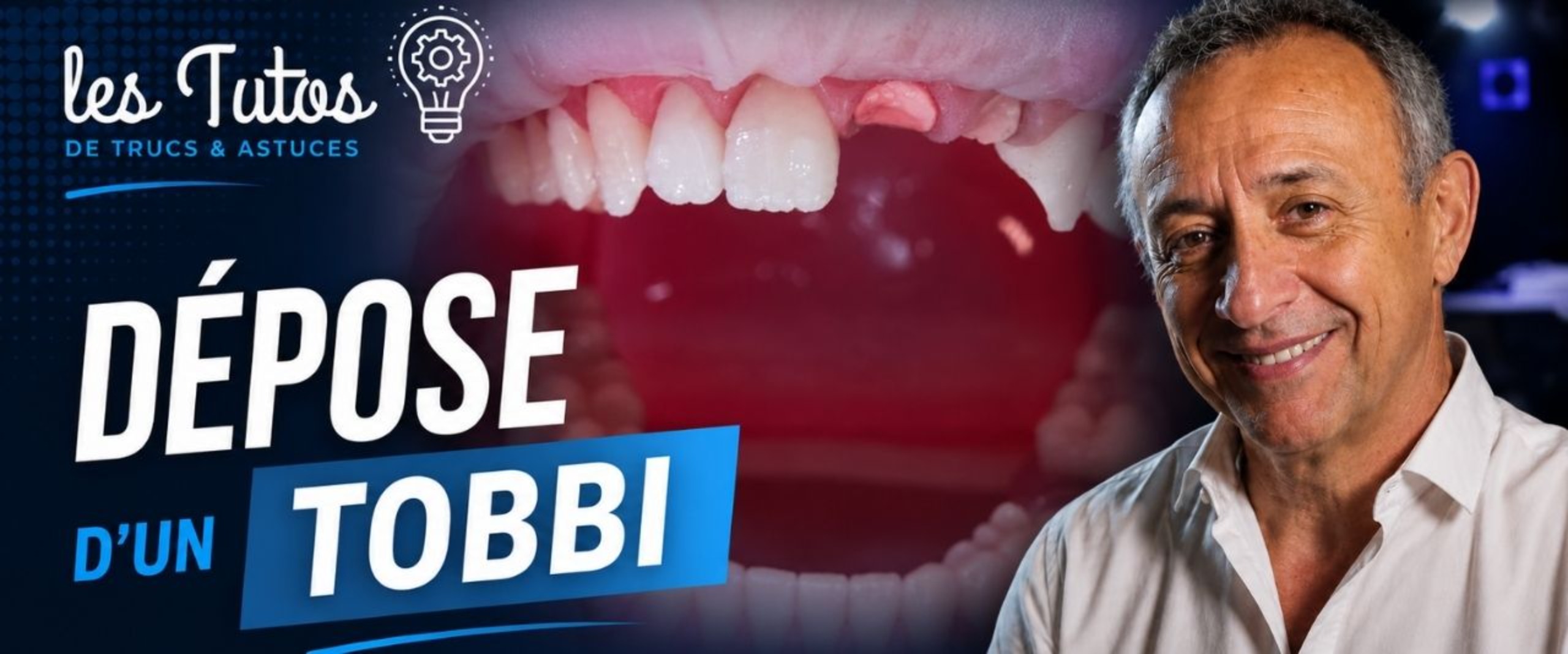 Dépose d'un tobbi (Tuto, saison 2 épisode 6) : Démonstration muette du Dr Jean Richelme : la dépose d'un TOBBI aux ultrasons et au Hollenbach, puis…