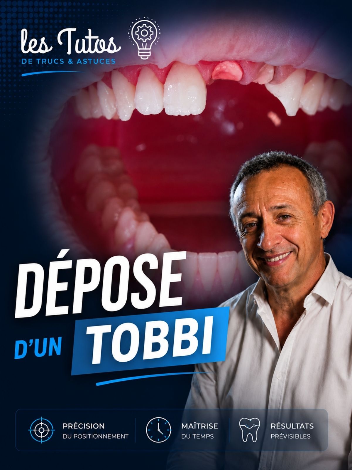 Dépose d'un tobbi (Tuto, saison 2 épisode 6) : Démonstration muette du Dr Jean Richelme : la dépose d'un TOBBI aux ultrasons et au Hollenbach, puis…