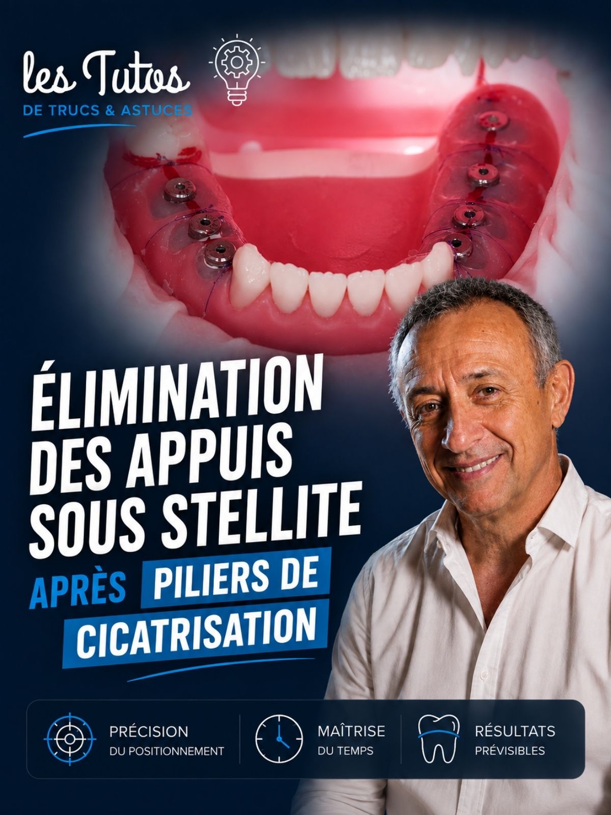 Elimination des appuis sous stellite apres piliers de cicatrisation (Tuto, saison 2 épisode 8) : Démonstration muette du Dr Jean Richelme : la…