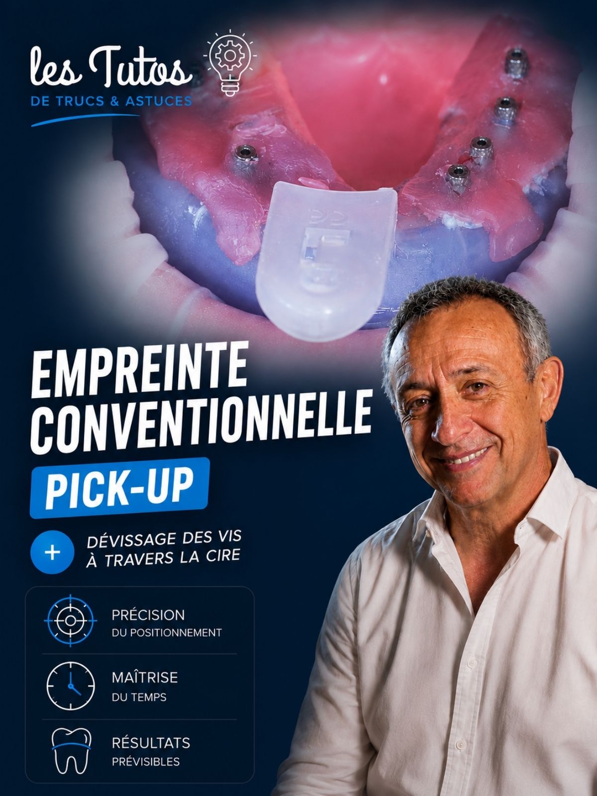 Empreinte conventionnelle pick up (Tuto, saison 2 épisode 9) : Démonstration muette du Dr Jean Richelme : la prise d'empreinte conventionnelle «…