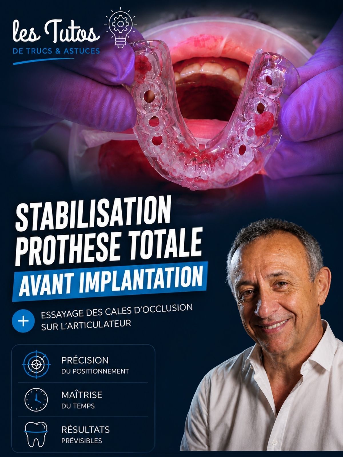 Stabilisation prothèse totale avant implantation (Tuto, saison 2 épisode 10) : Démonstration muette du Dr Jean Richelme : stabiliser une prothèse…