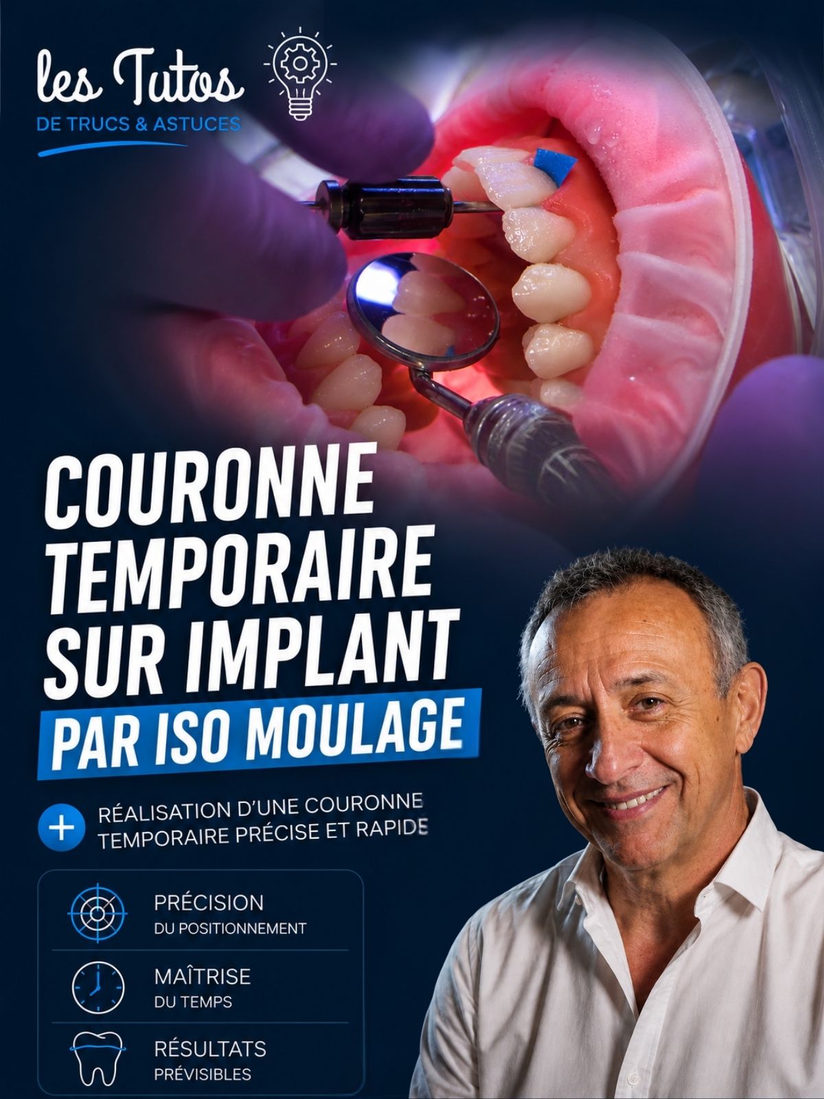 Couronne temporaire sur implant par iso moulage (Tuto, saison 2 épisode 11) : Démonstration muette du Dr Jean Richelme : la réalisation d'une…